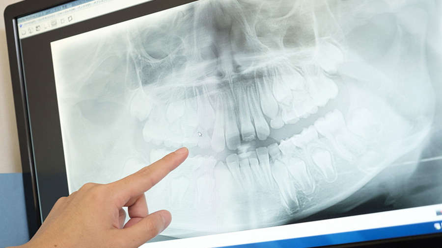 レントゲンの安全性