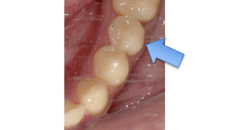 セラミックケース5アフター