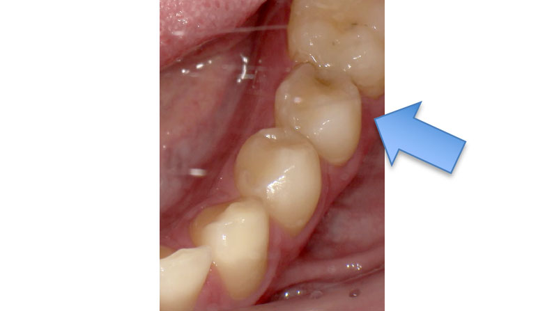 セラミックケース5ビフォアー