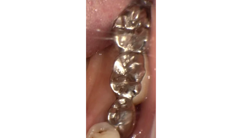 セラミックケース5ビフォアー