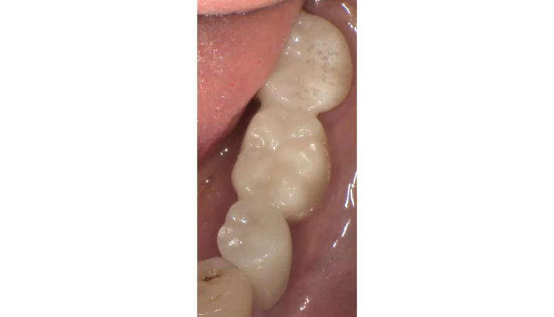 セラミックケース5アフター