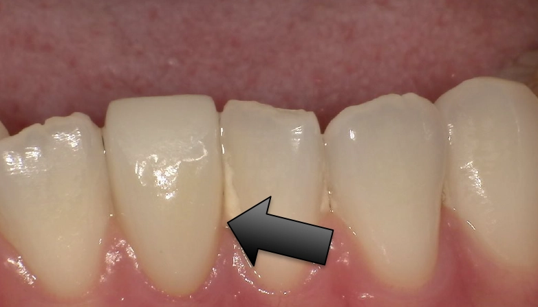 セラミックケース5アフター